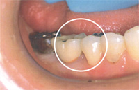 丸印がインプラント治療した歯